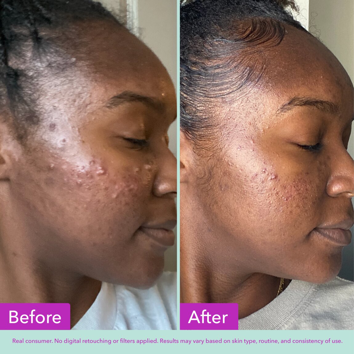 acne-foaming-cleanser-f7 zb_p.jpg
